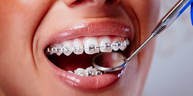 Transform Your Smile with Expert Dental Braces Treatment at Dr. Balaji Dental Hospital - Dr Balaji Dental Hospital and Medical Centre