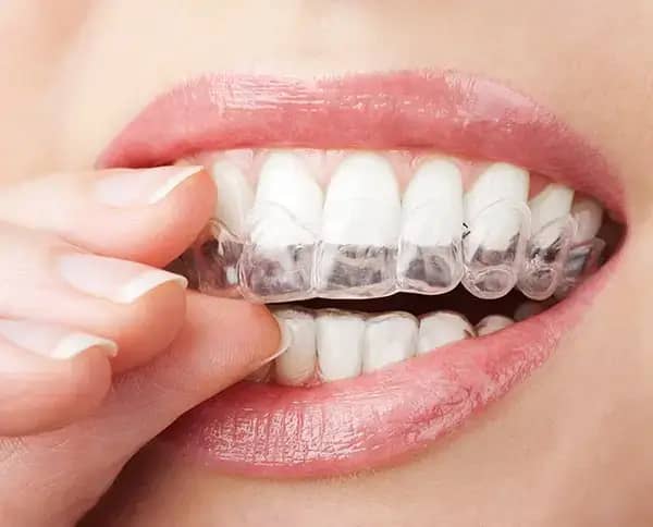 Invisalign Aligners
