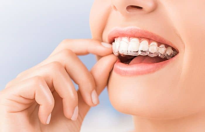 Invisible Braces Cost in Chennai