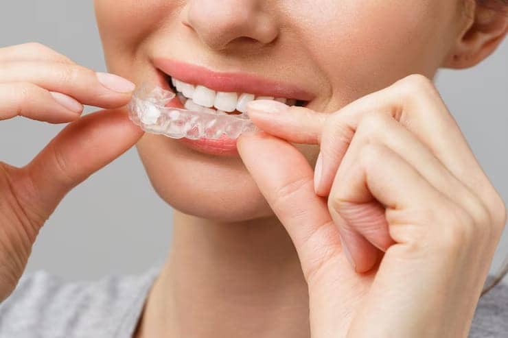 Aligners Work to Straighten Teeth