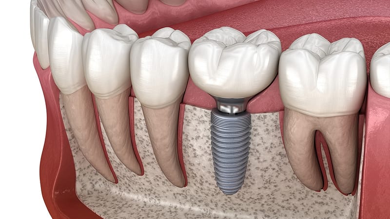 Dental Implants in Tambaram