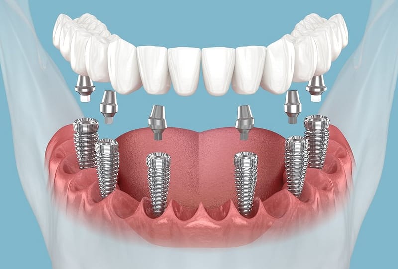 Implant